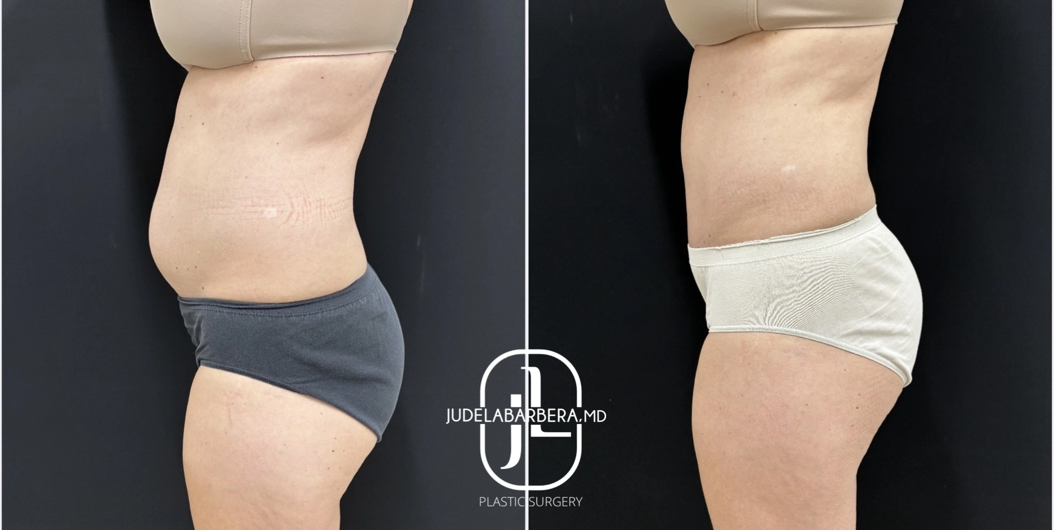 Before and after abdominal contouring, side view showing improved abdominal contour