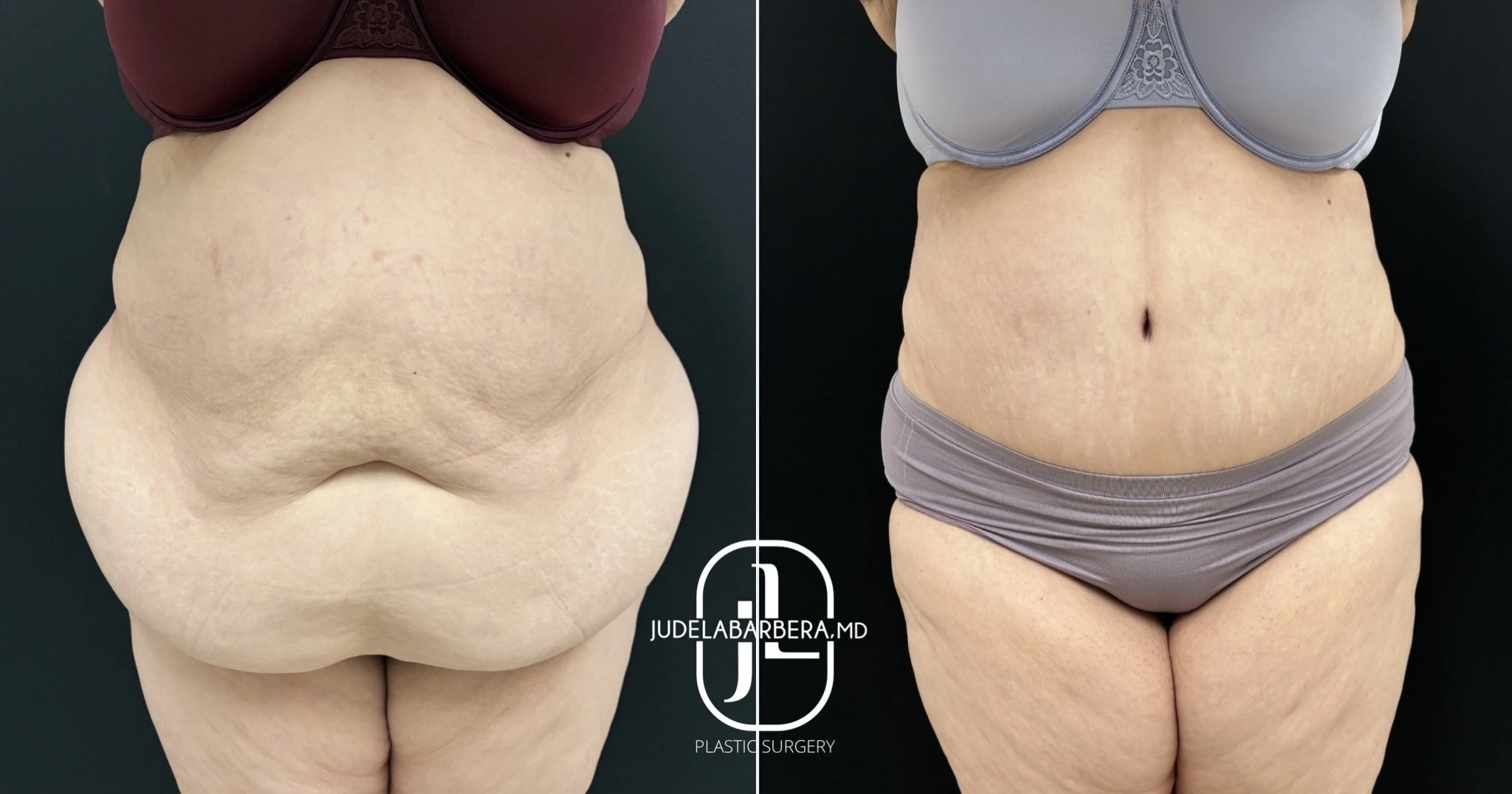 Before and after abdominal contouring surgery showing reduced midsection fullness and improved waistline definition