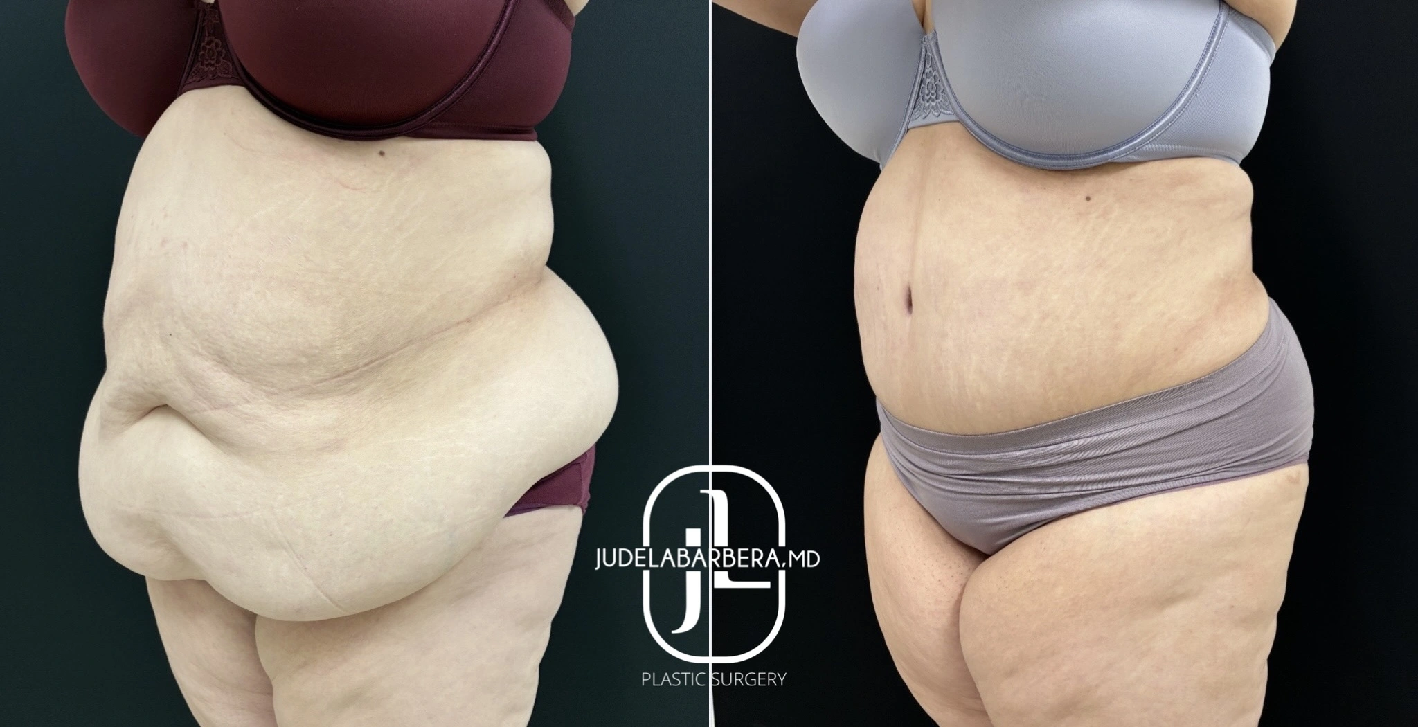 Before and after side view of abdominal liposuction showing flattened abdomen and refined waist contour