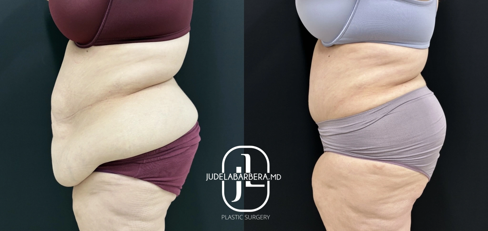 Before and after side profile of tummy tuck demonstrating tightened abdominal skin and improved body contour