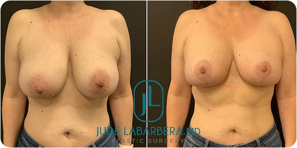 Breast reduction before and after results showing reduced size and lift, Jude LaBarbera MD logo