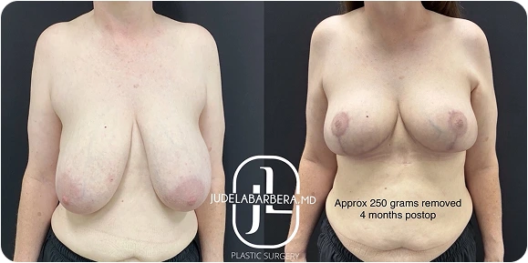Breast reduction before and after results, approximately 250 grams removed at 4 months postop, Jude LaBarbera MD logo