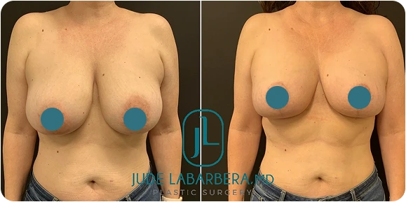 Breast Reduction in Gilbert, AZ Before and After A Banner