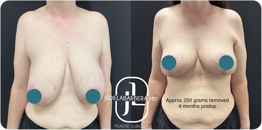 Breast Reduction in Gilbert, AZ Before and After B Banner