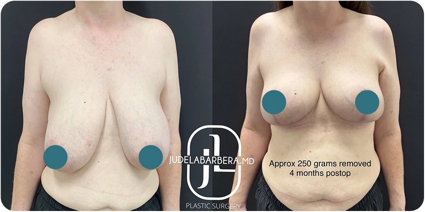 Breast Reduction in Gilbert, AZ Before and After B Banner
