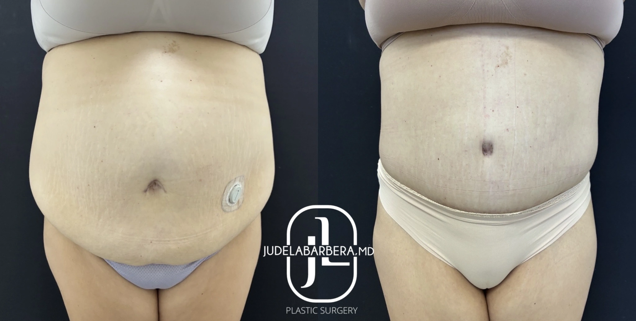 Before and after abdominoplasty, front view showing flattened abdomen and repositioned belly button