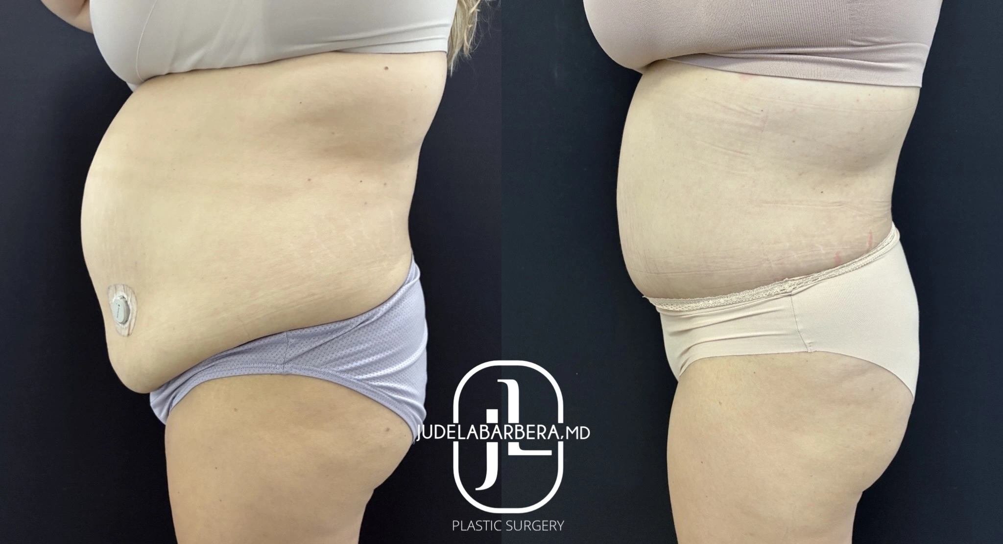 Before and after abdominoplasty, side view showing reduced abdominal fullness and improved contour
