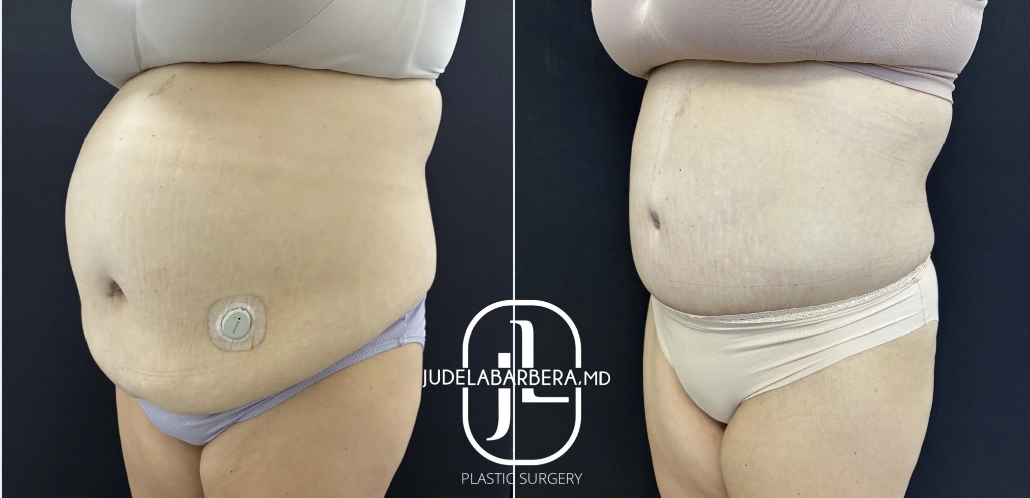 Before and after abdominal liposuction and skin tightening showing reduced abdominal fullness and contoured midsection