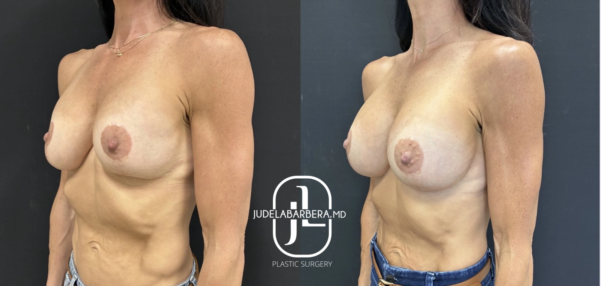 Before and after breast augmentation displaying improved breast symmetry and fuller appearance