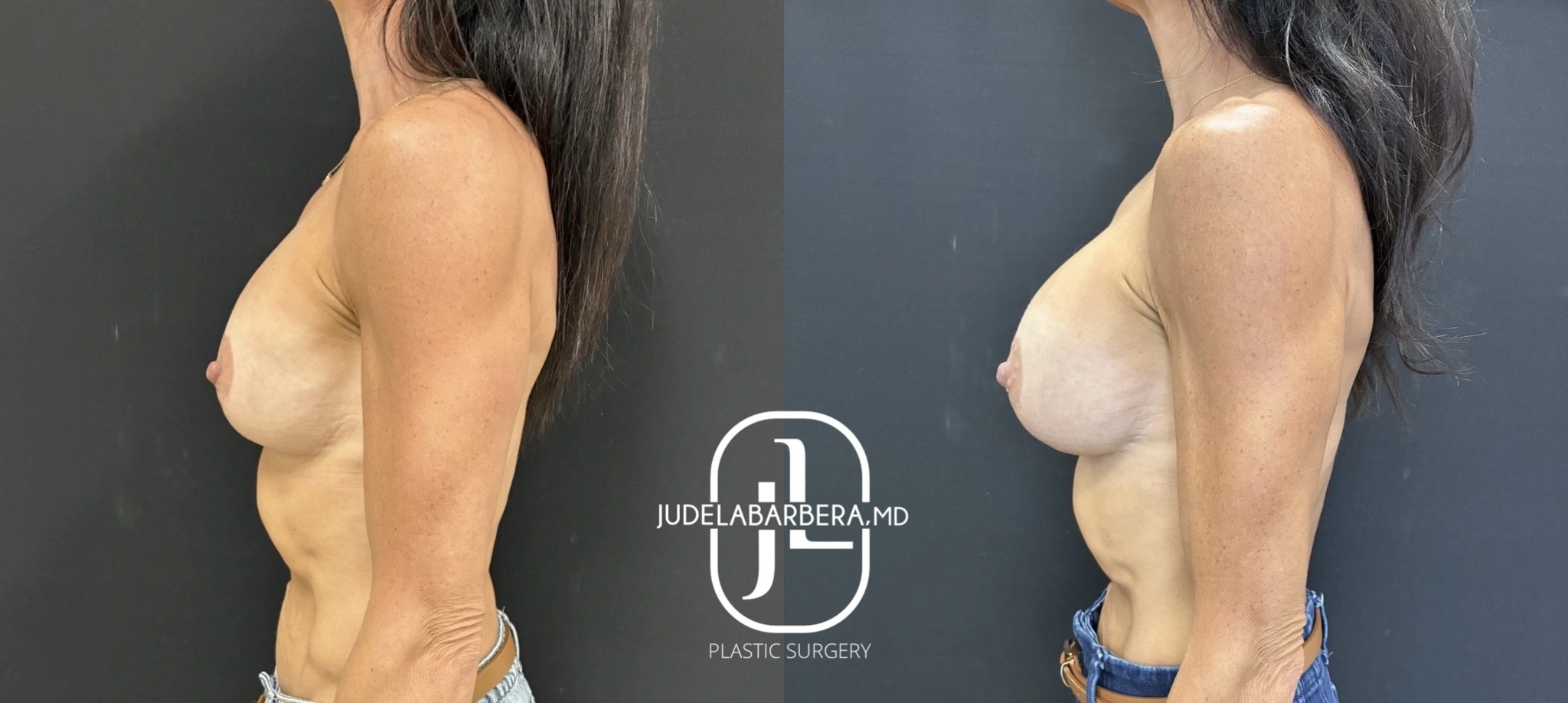 Before and after breast augmentation showing side profile with enhanced breast volume and projection