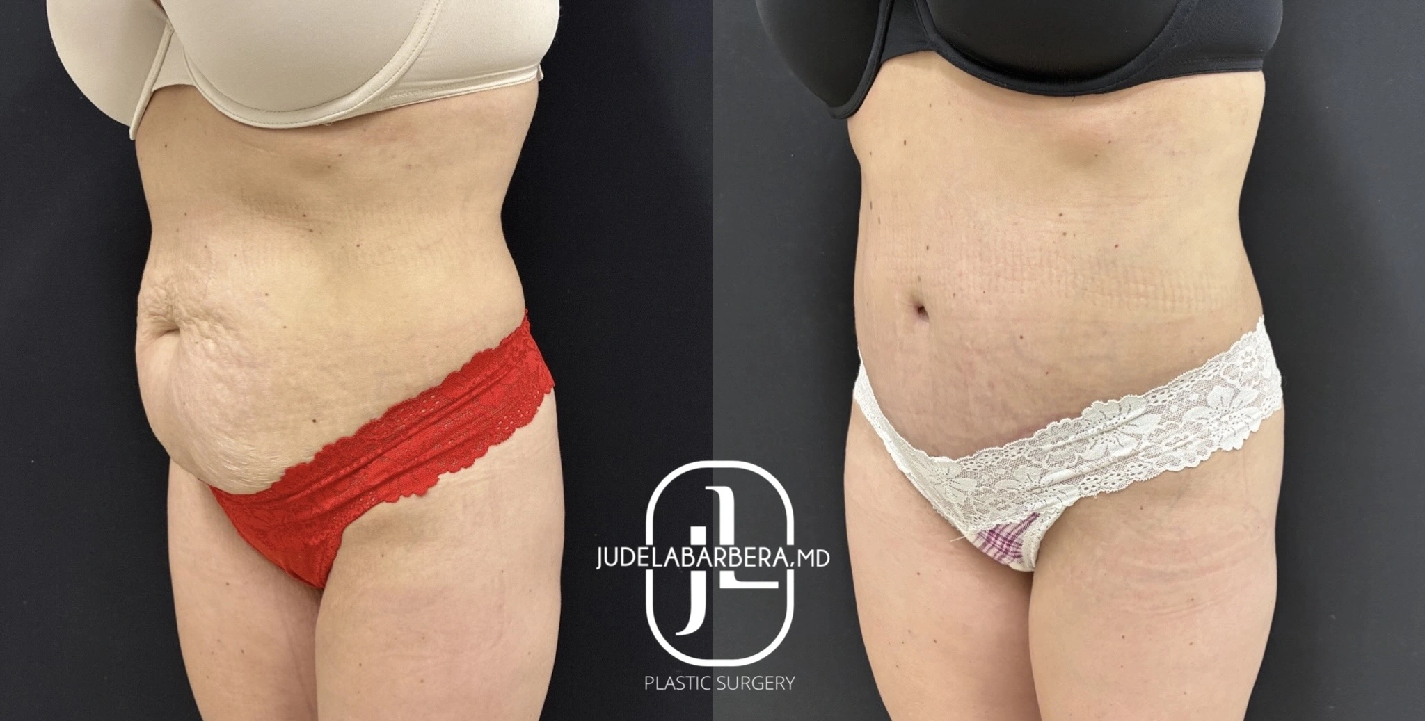 Before and after abdominal contouring surgery showing reduced abdominal laxity and improved waist definition