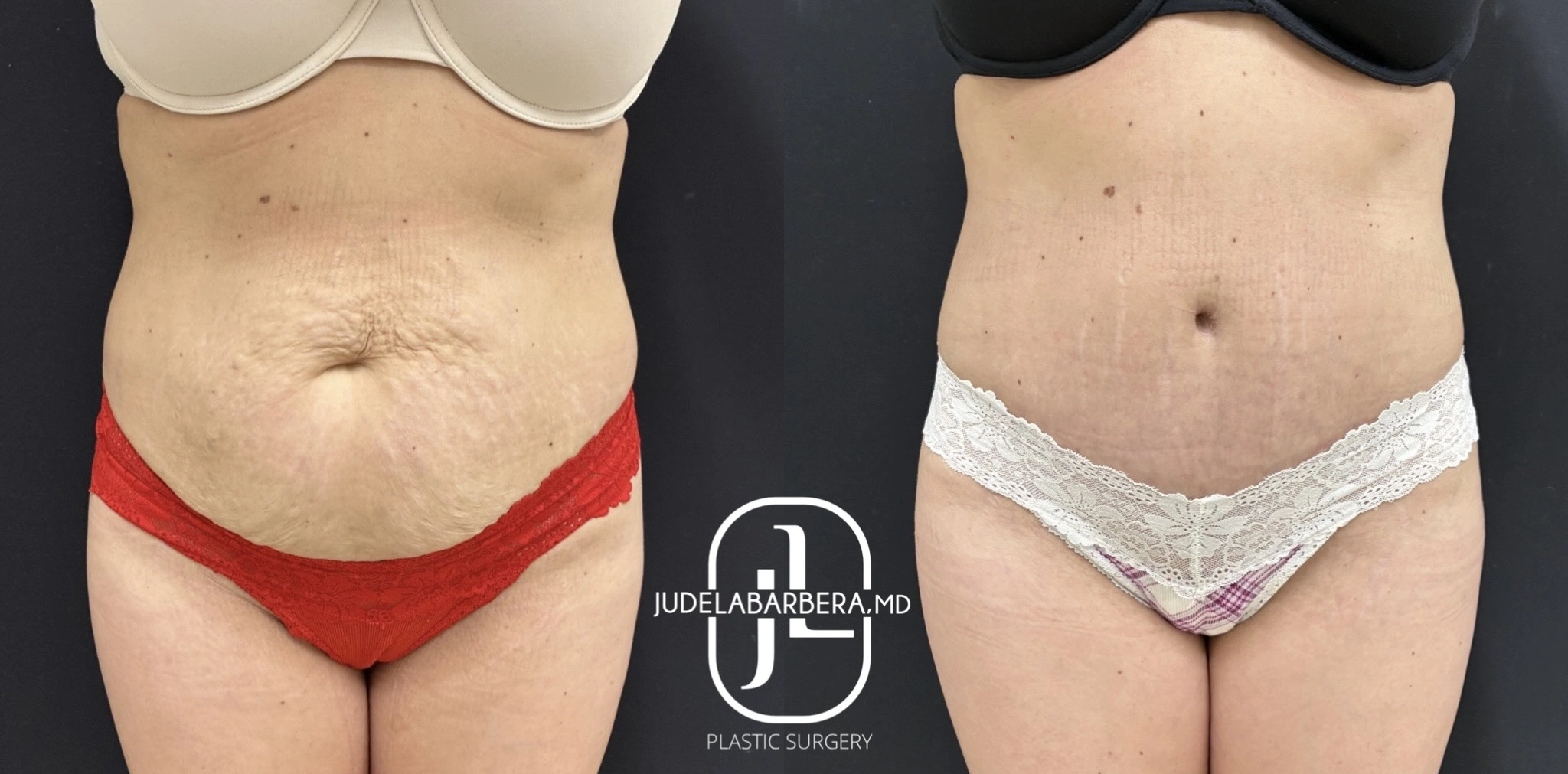 Before and after abdominal contouring displaying flattened abdomen and tightened midsection