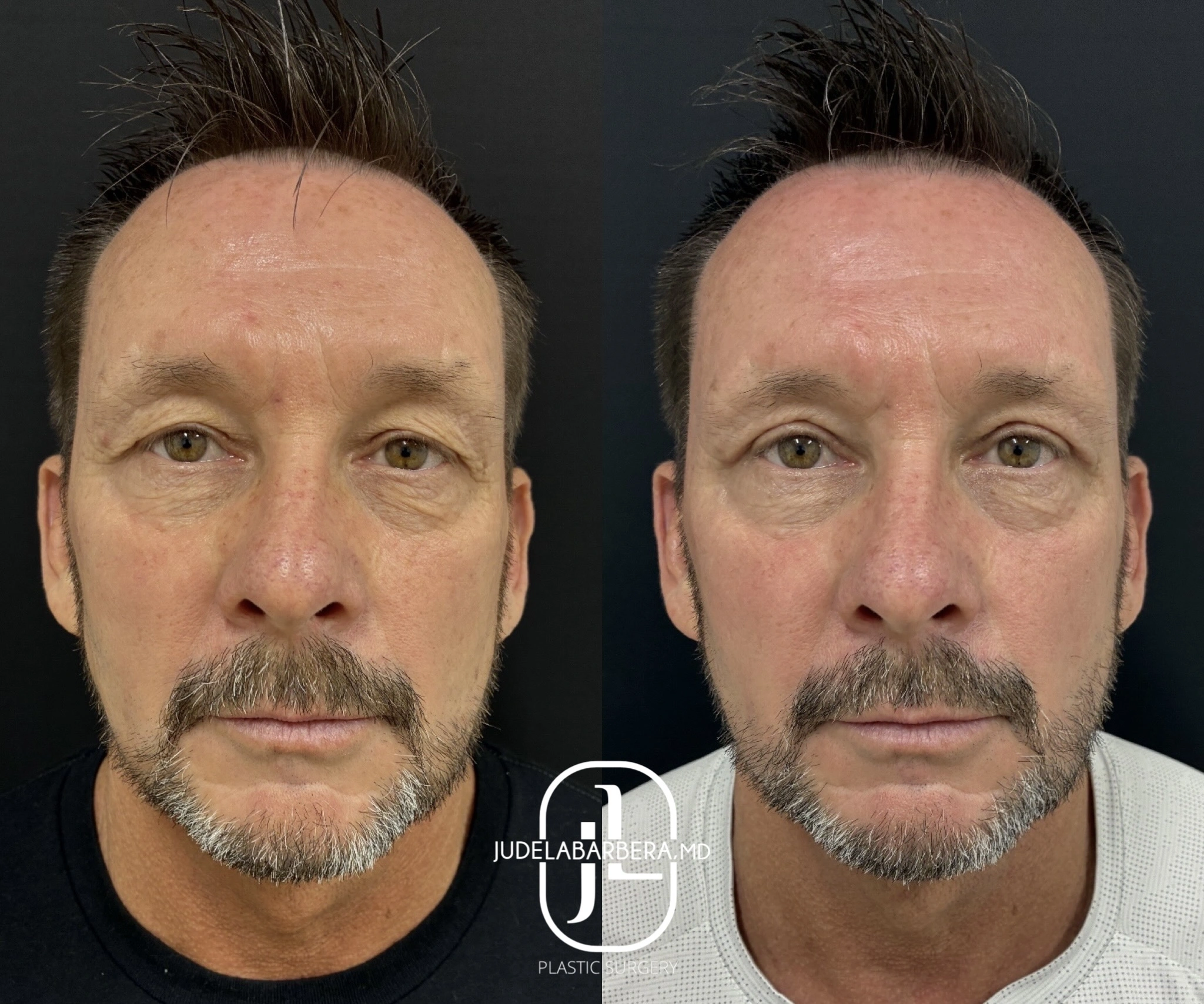 Before and after facial comparison showing skin texture improvement with Judelabarrera MD logo
