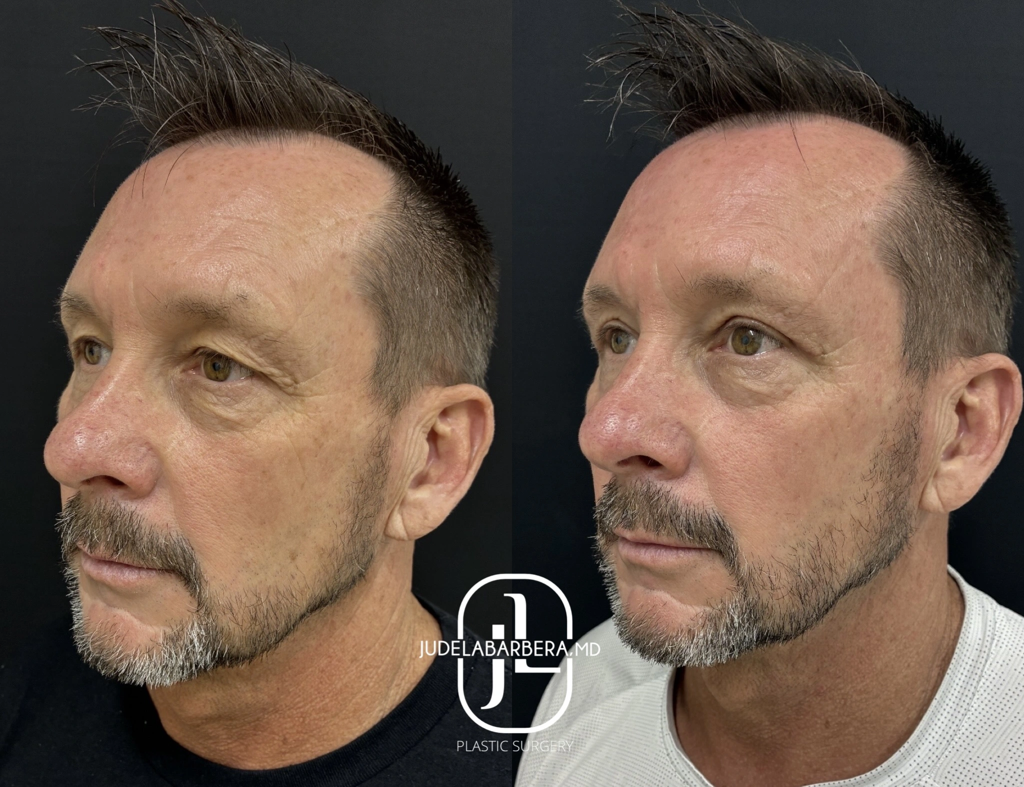 Before and after side profile of male face showing facial contouring results