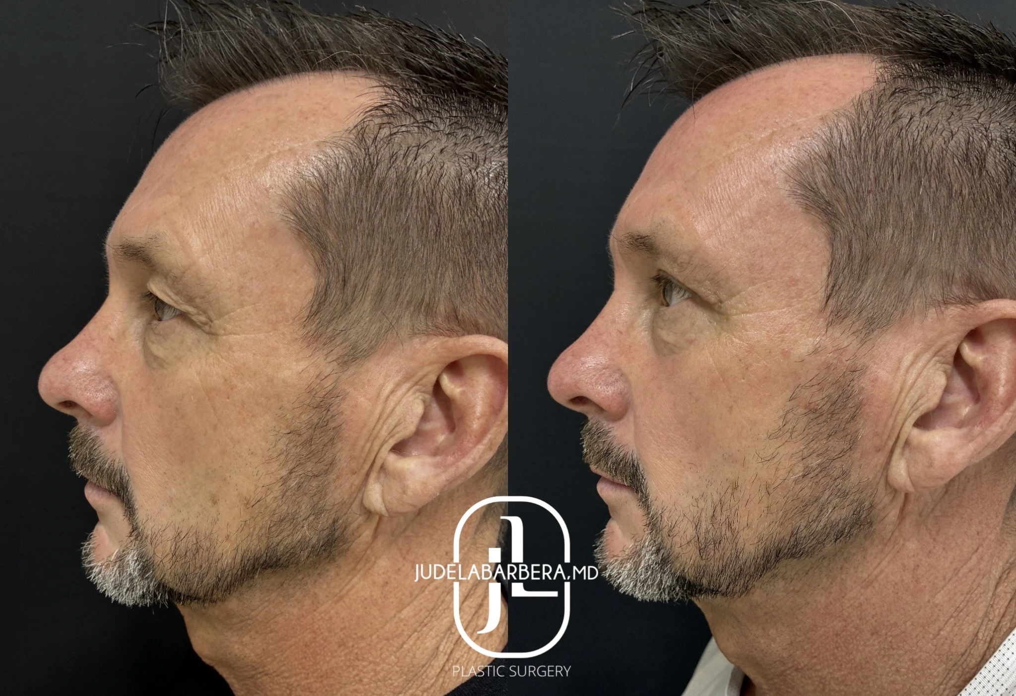 Before and after side profile of male face showing facial rejuvenation results