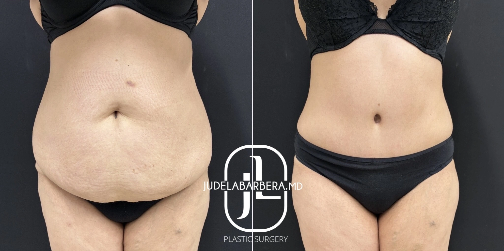 Before and after full abdomen comparison showing body contouring results with Judelabarrera MD logo