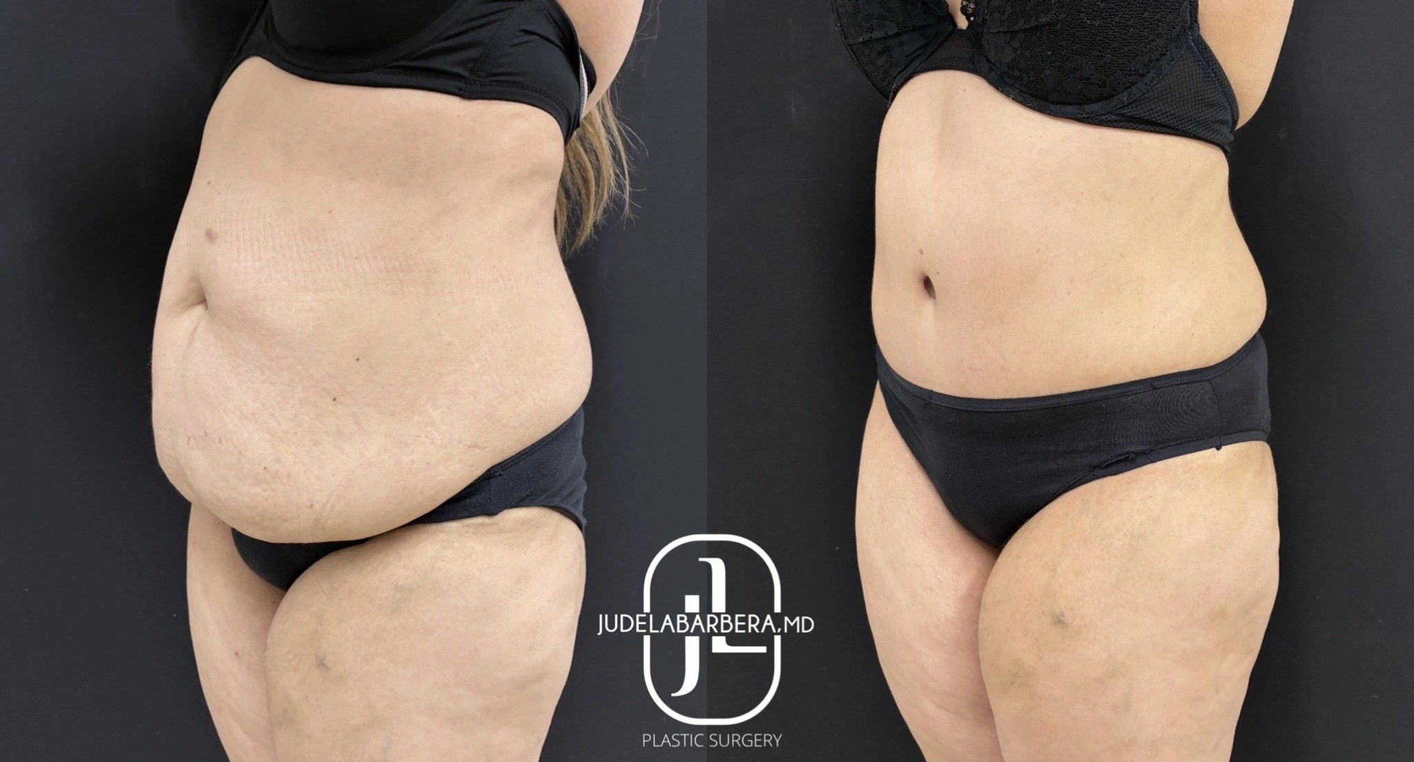 Before and after midsection and hip comparison showing body contouring results with Judelabarrera MD logo