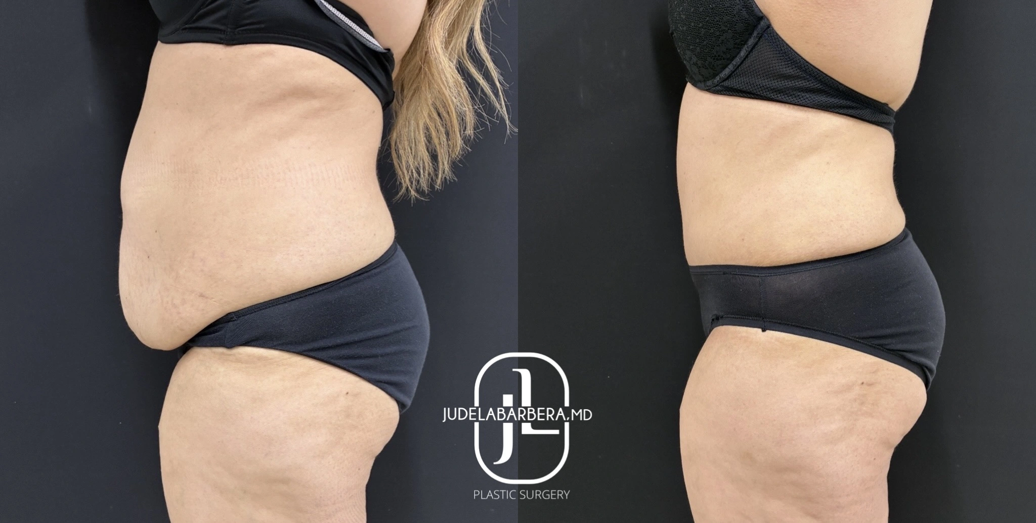 Before and after abdomen and thigh comparison showing body contouring results with Judelabarrera MD logo