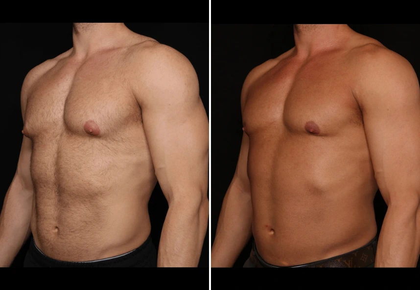Before and after male chest contouring, side view showing reduced chest fullness