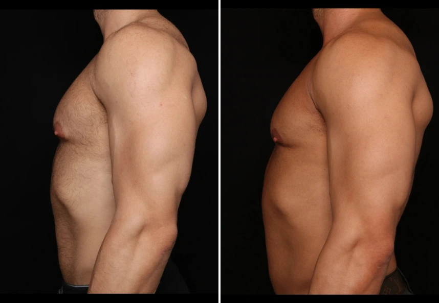 Before and after side profile showing torso and chest definition
