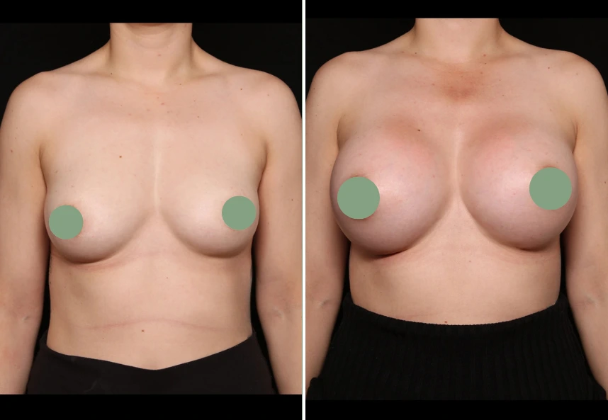 Before and after breast augmentation comparison, front view