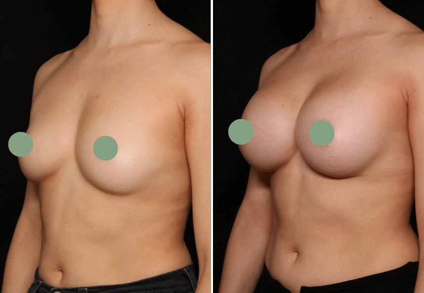 Before and after breast augmentation comparison photos