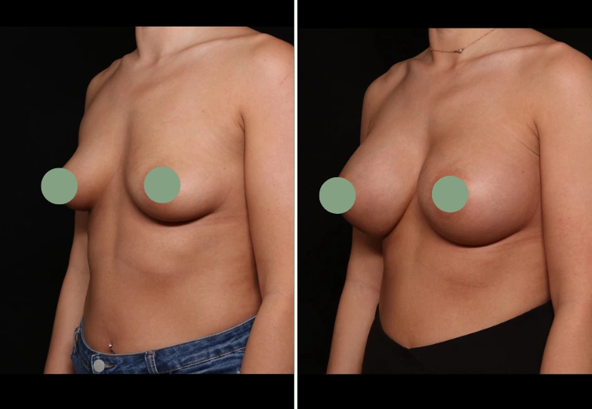 Before and after breast augmentation comparison, side view