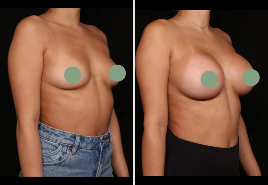 Before and after breast augmentation comparison, front view