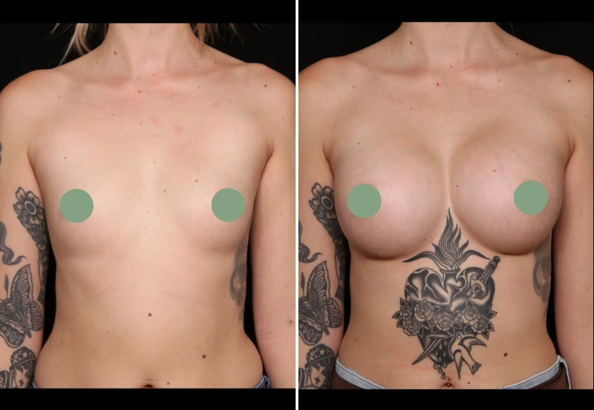 Before and after breast augmentation comparison photos