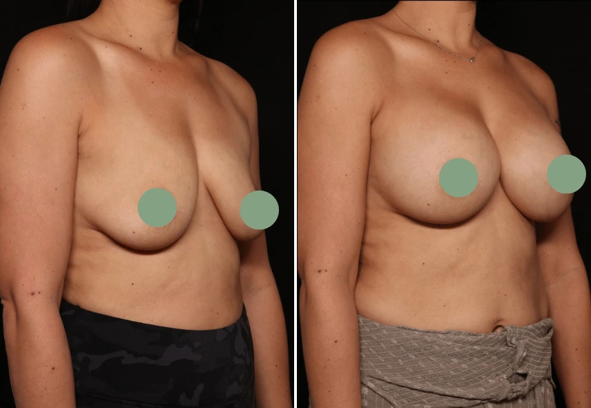 Before and after breast augmentation comparison photos