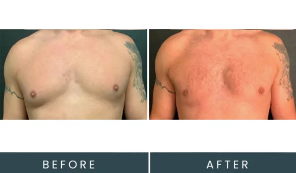 Before and after chest comparison showing male patient frontal view with reddened skin tone in after image