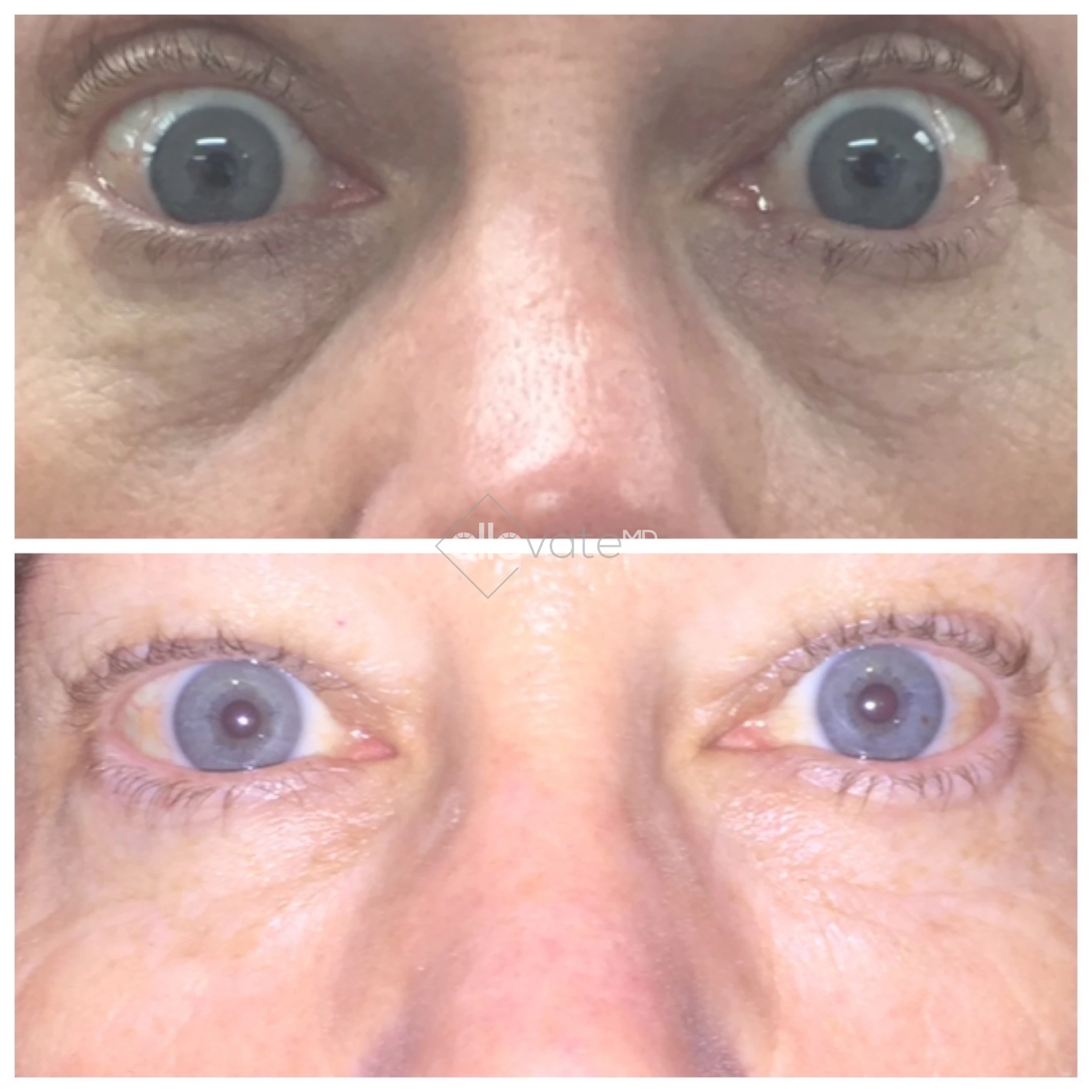 Eye Bag Removal 3 before and after