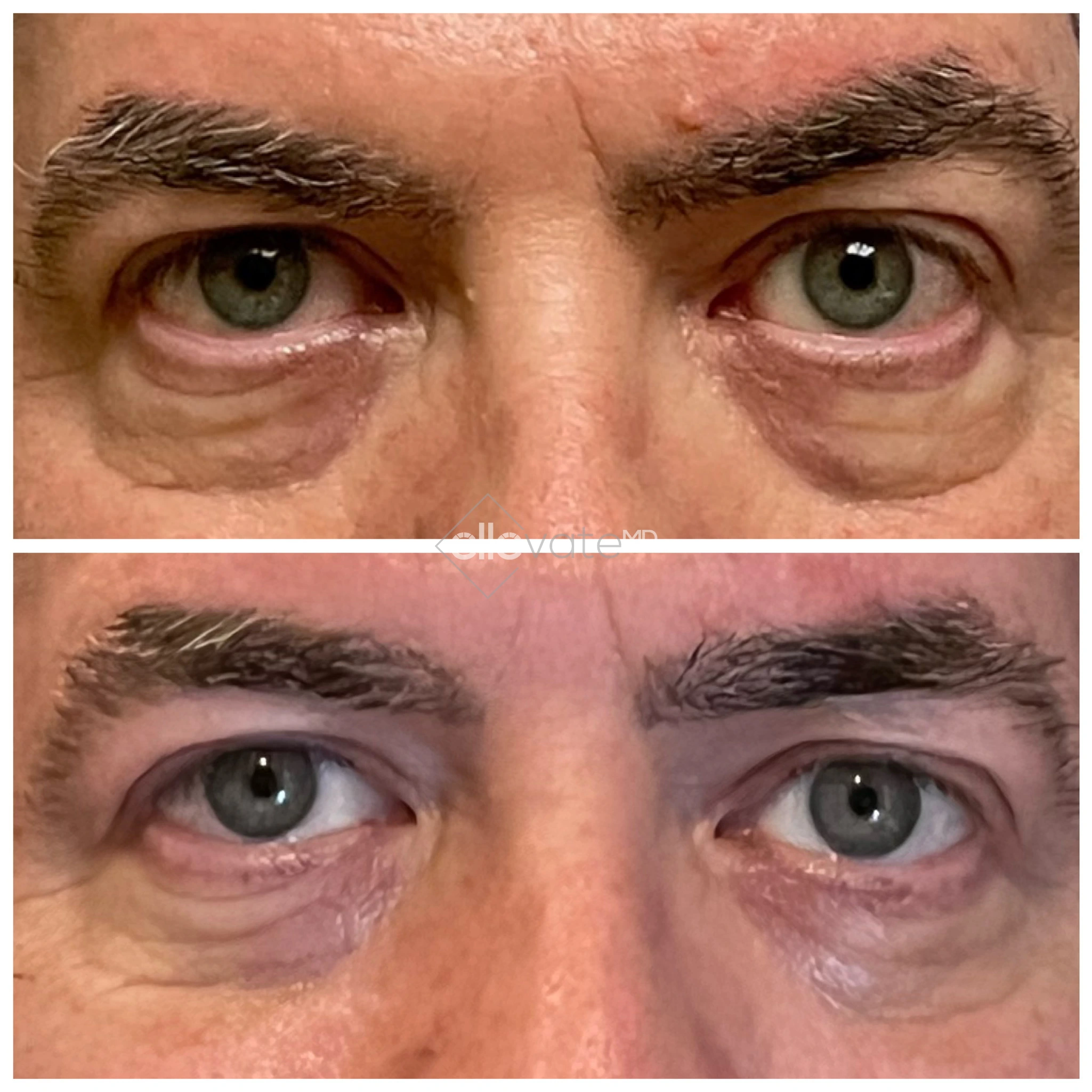 Eye Bag Removal 4 before and after