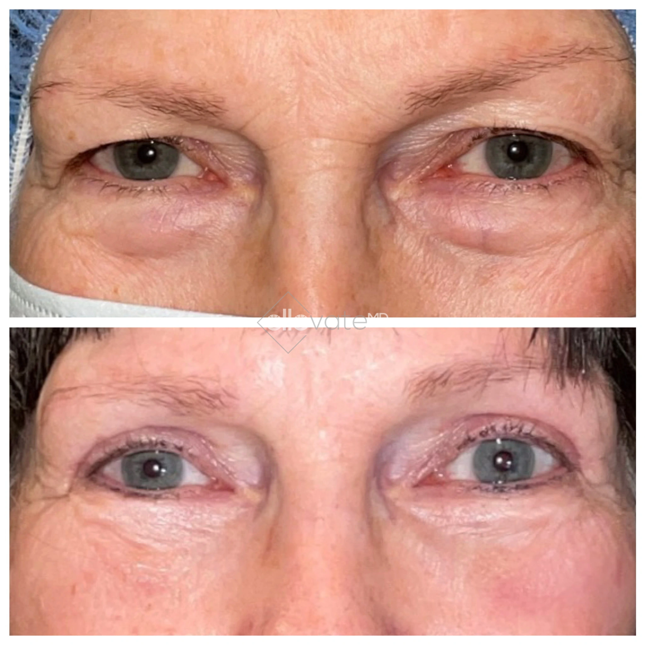 Eye Bag Removal 5 before and after