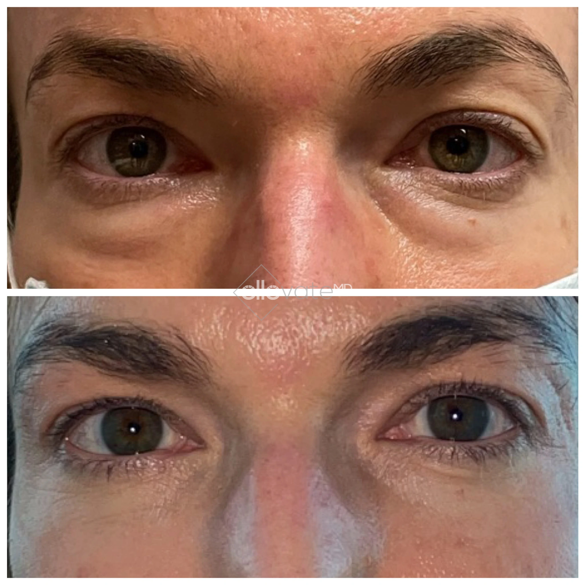 Eye Bag Removal 6 before and after