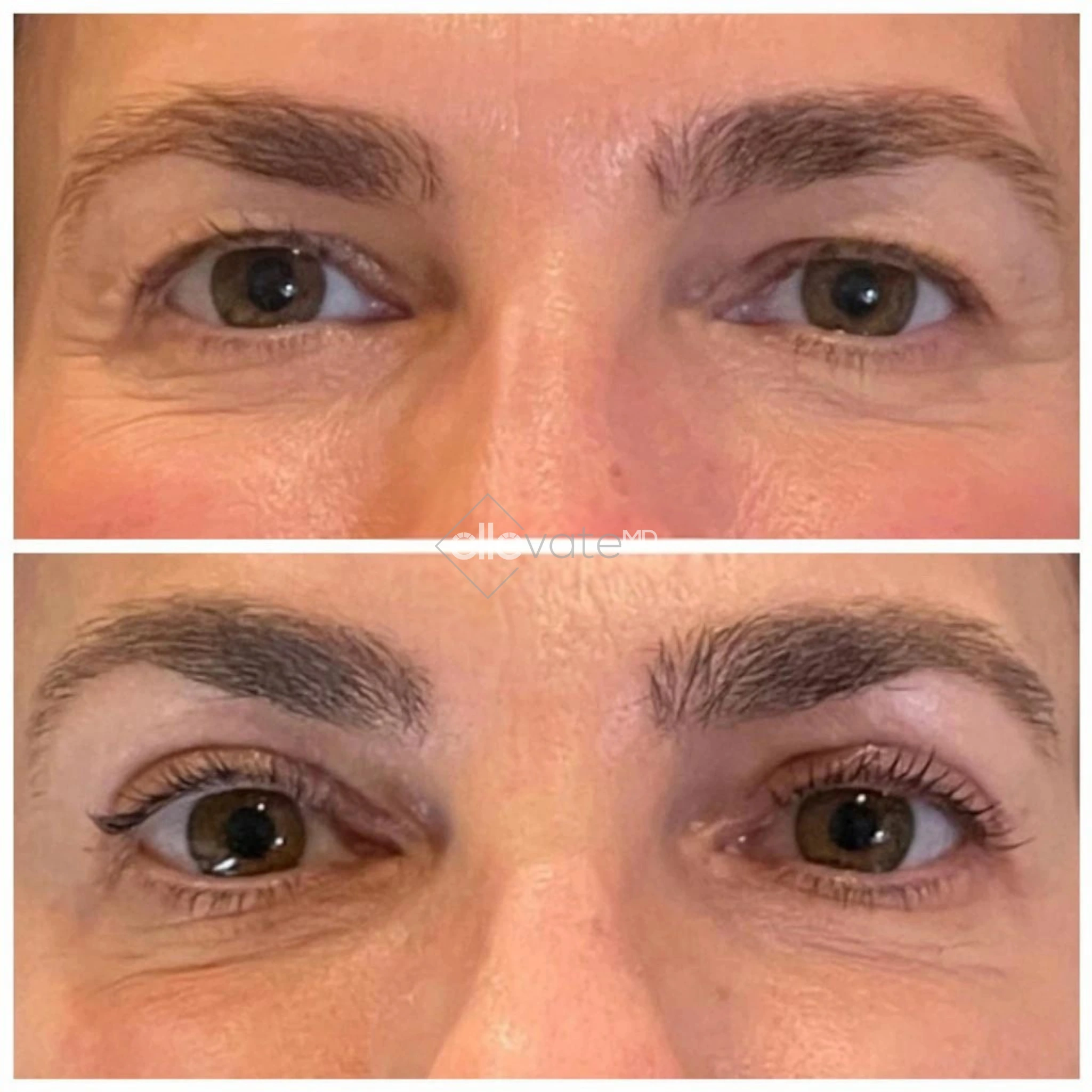 Signature Lift 128 before and after