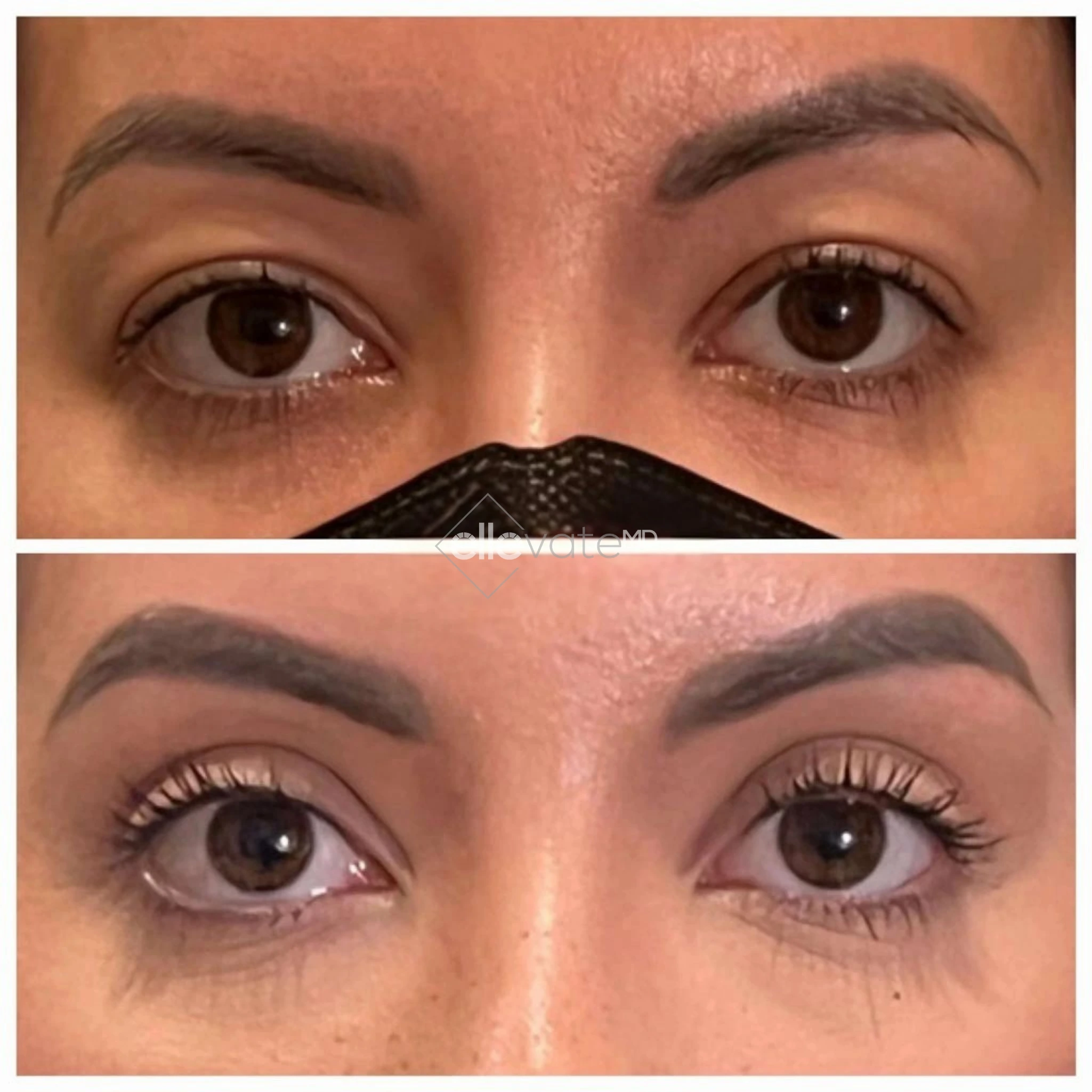 Signature Lift 129 before and after