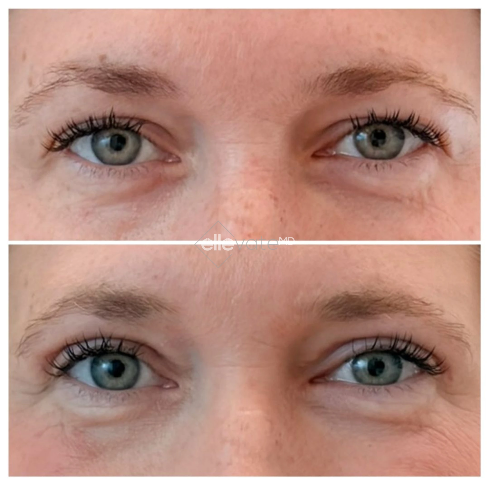 Signature Lift 217 before and after