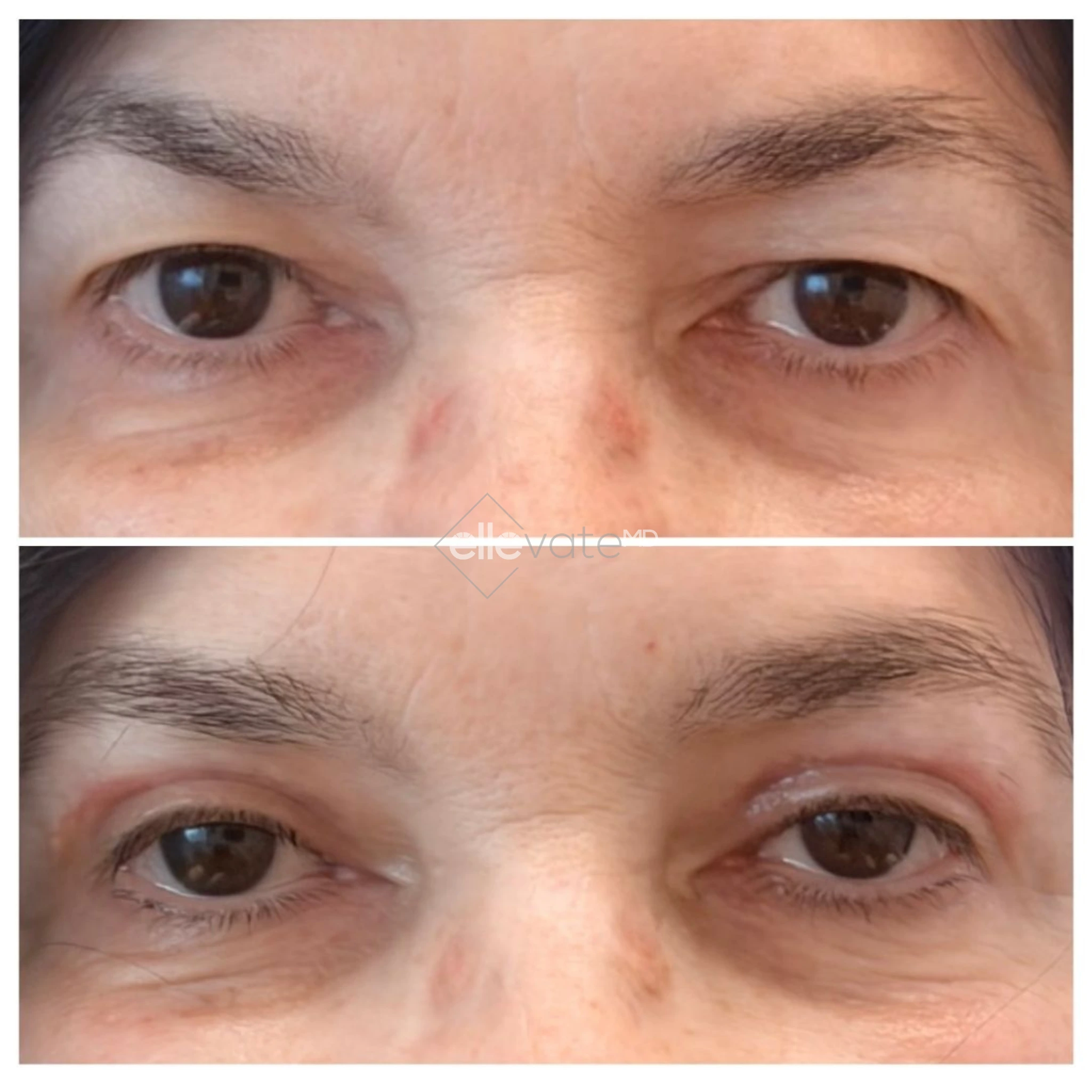 Signature Lift 230 before and after
