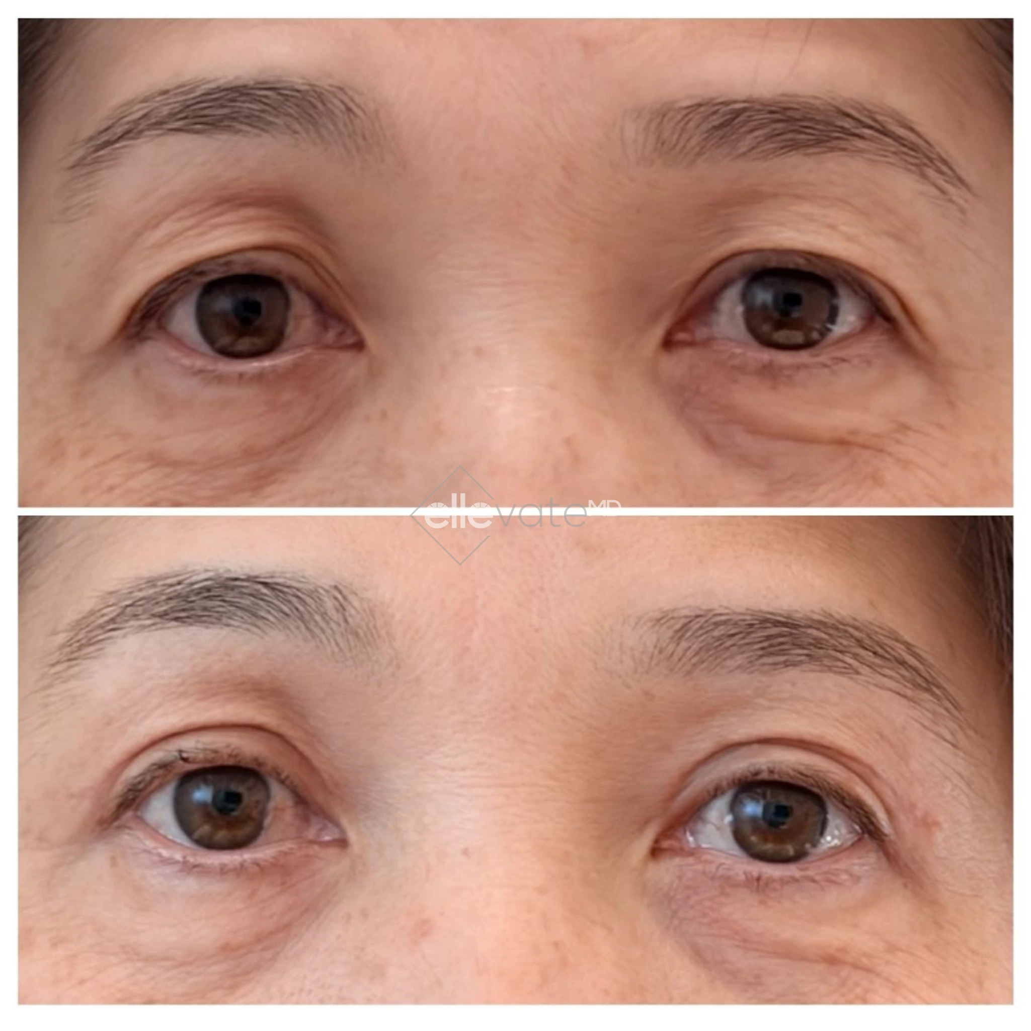 Signature Lift 231 before and after