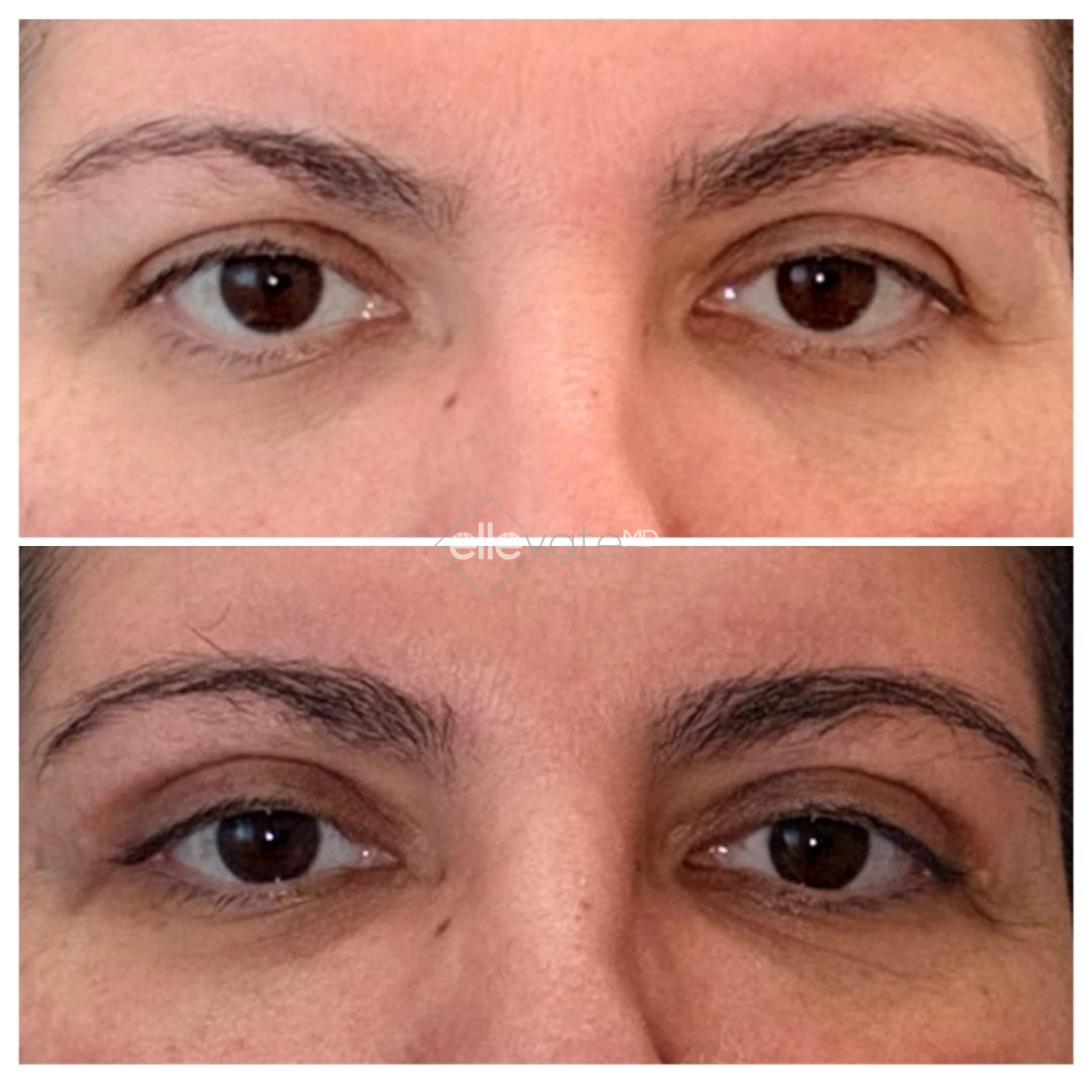 Signature Lift 232 before and after