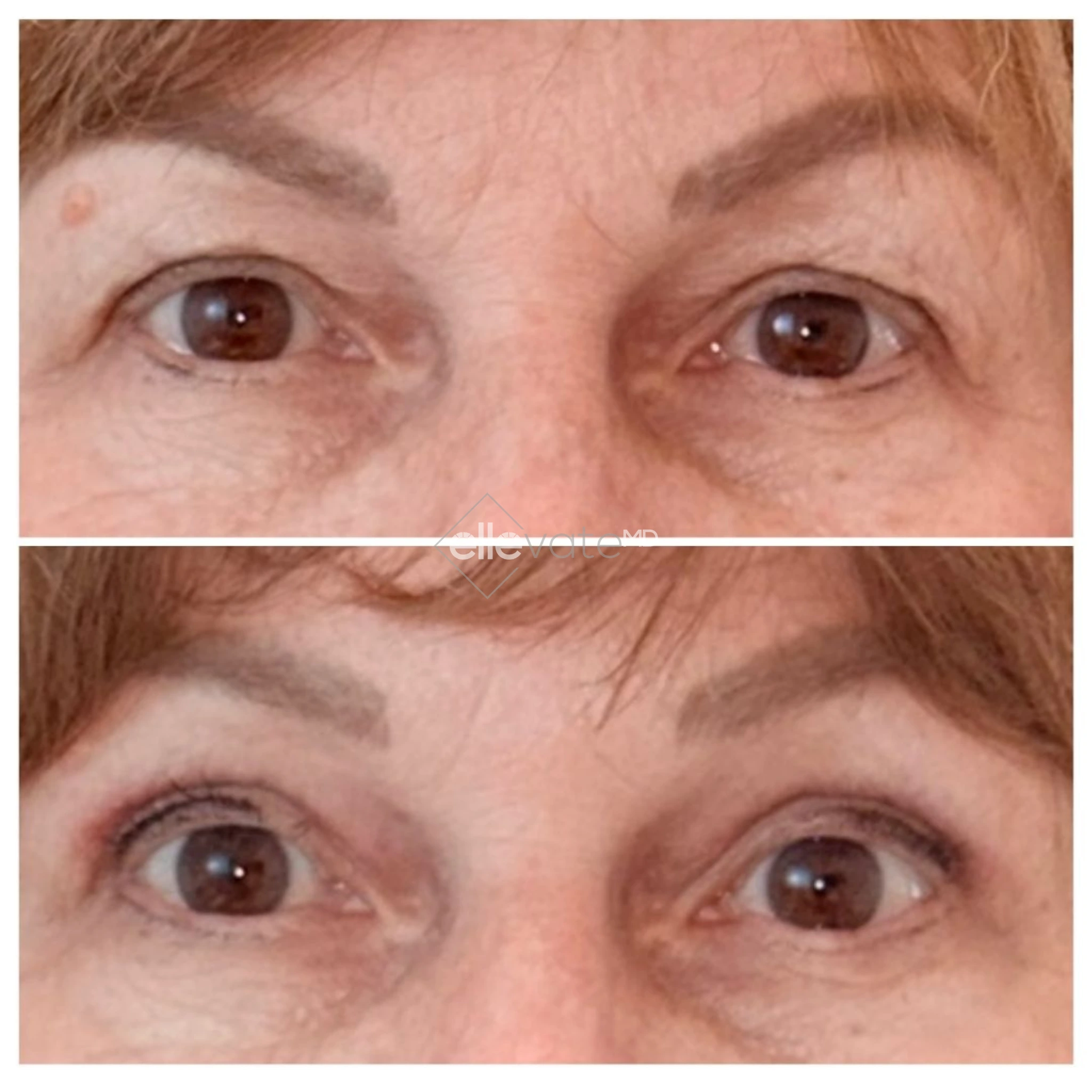 Signature Lift 233 before and after