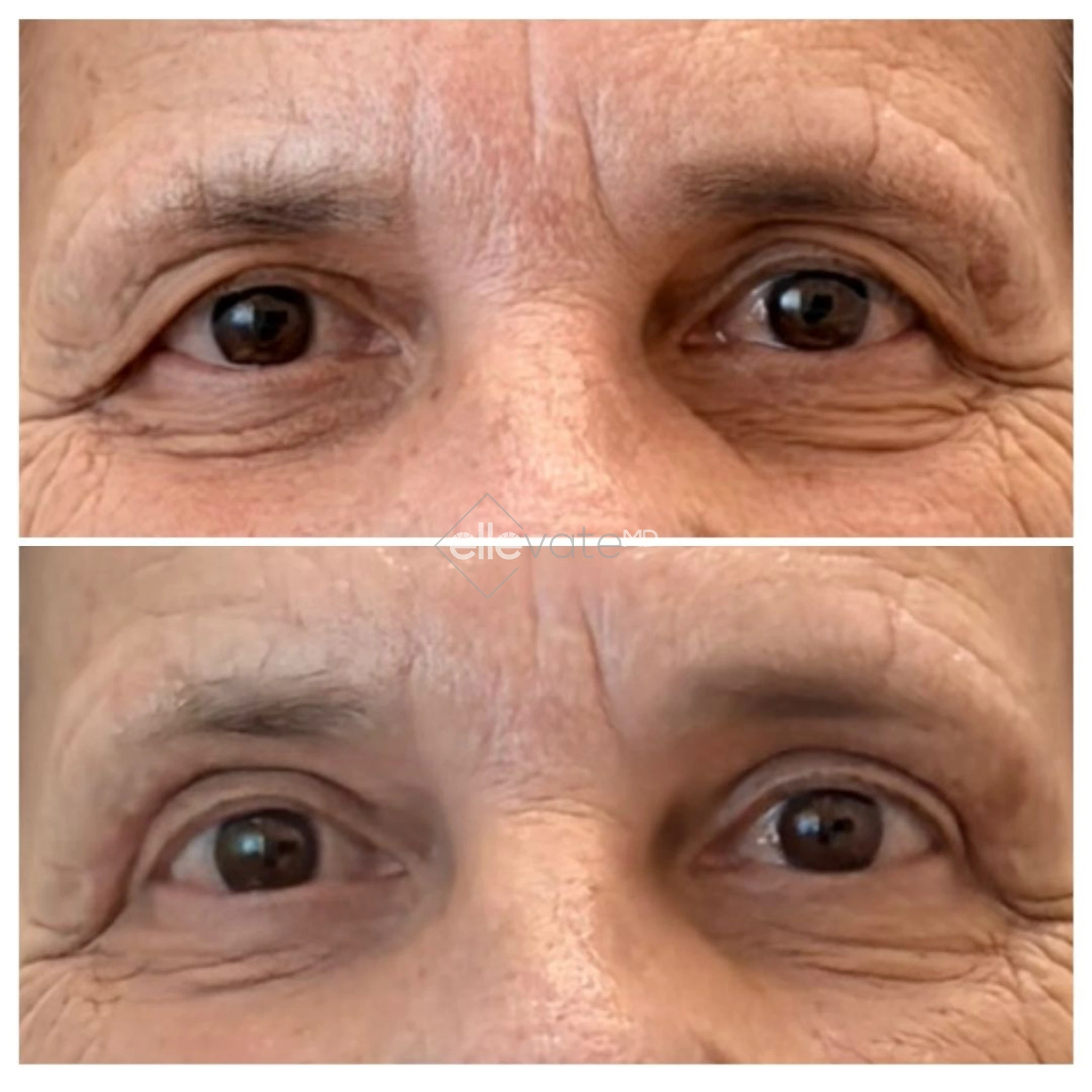 Signature Lift 234 before and after