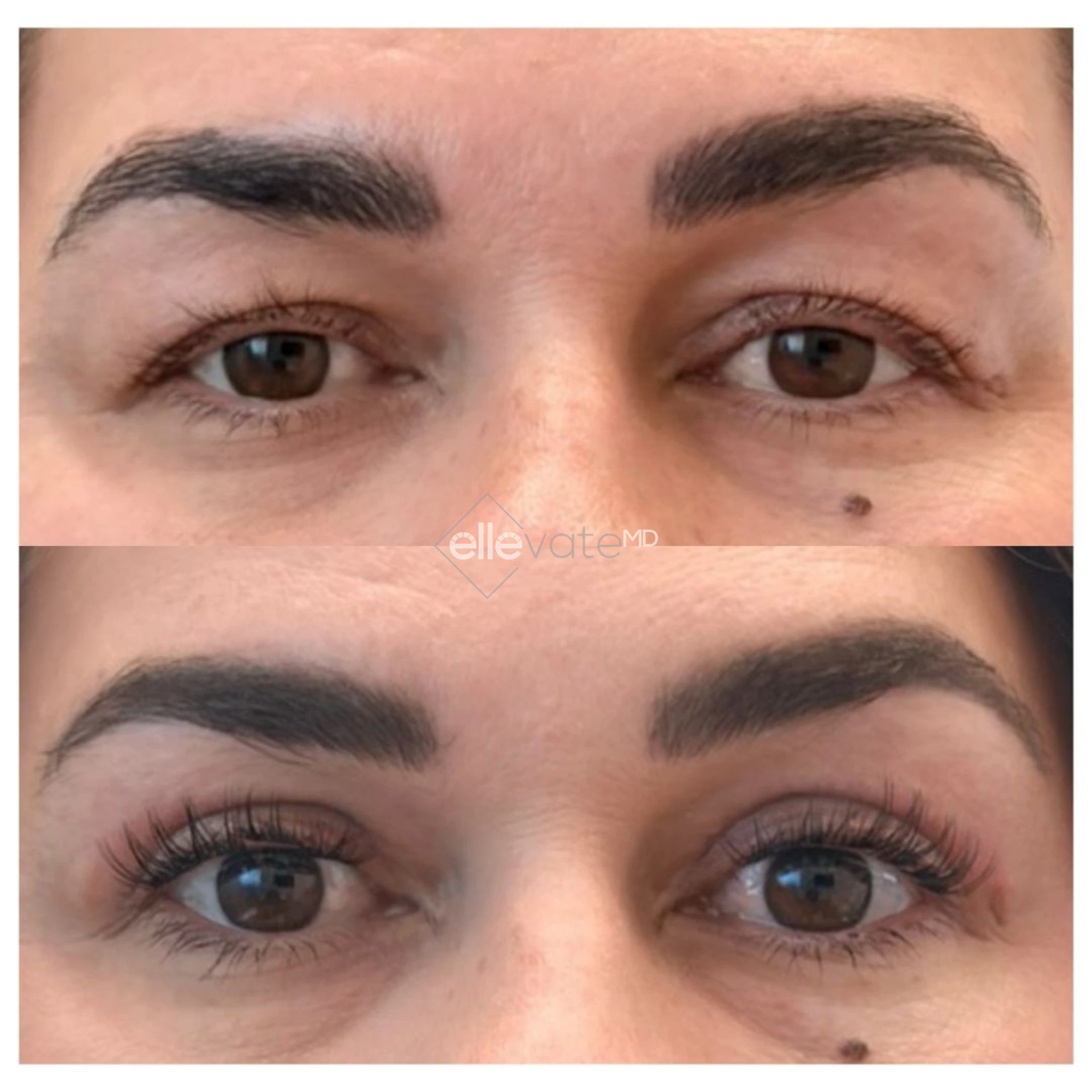 Signature Lift 235 before and after