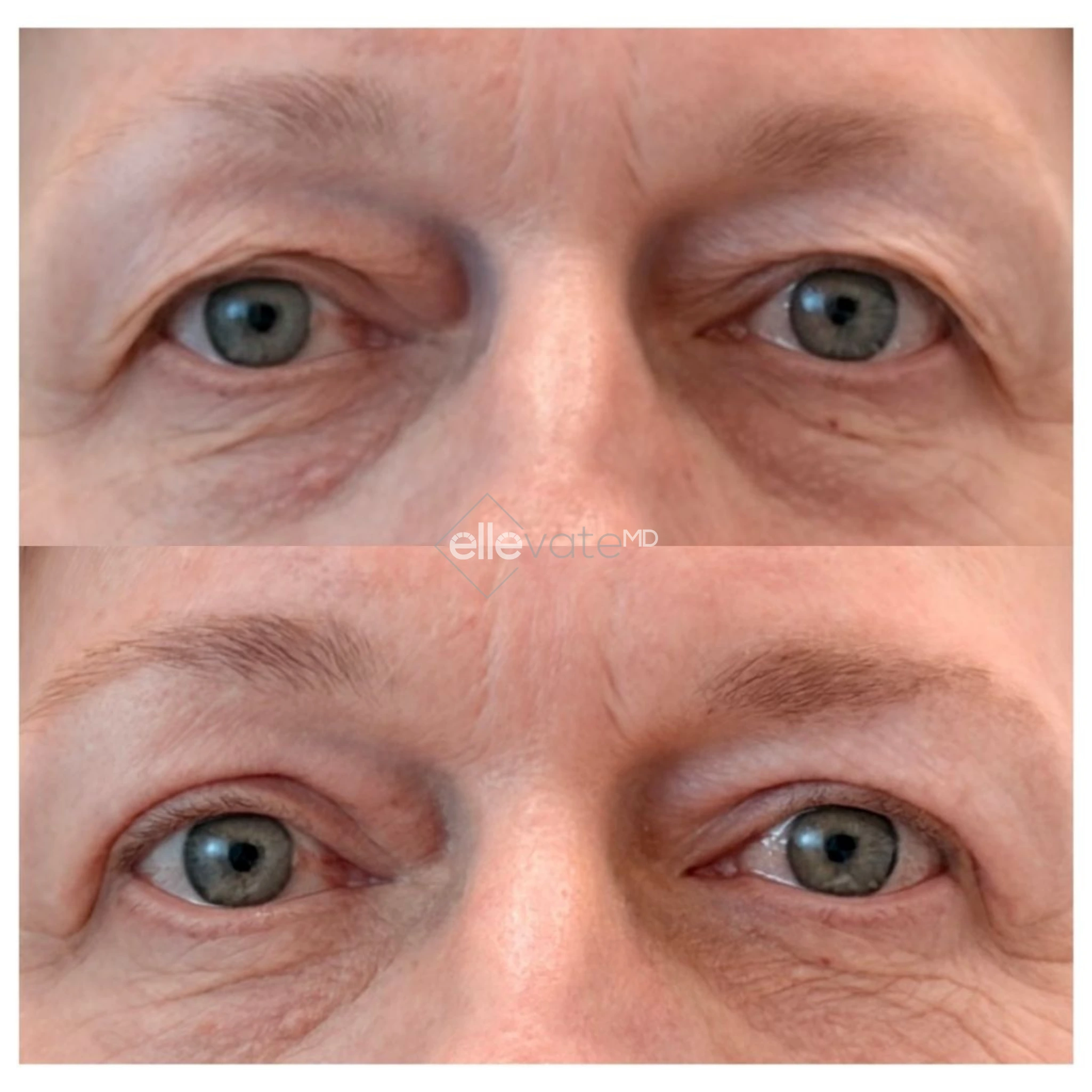 Signature Lift 236 before and after