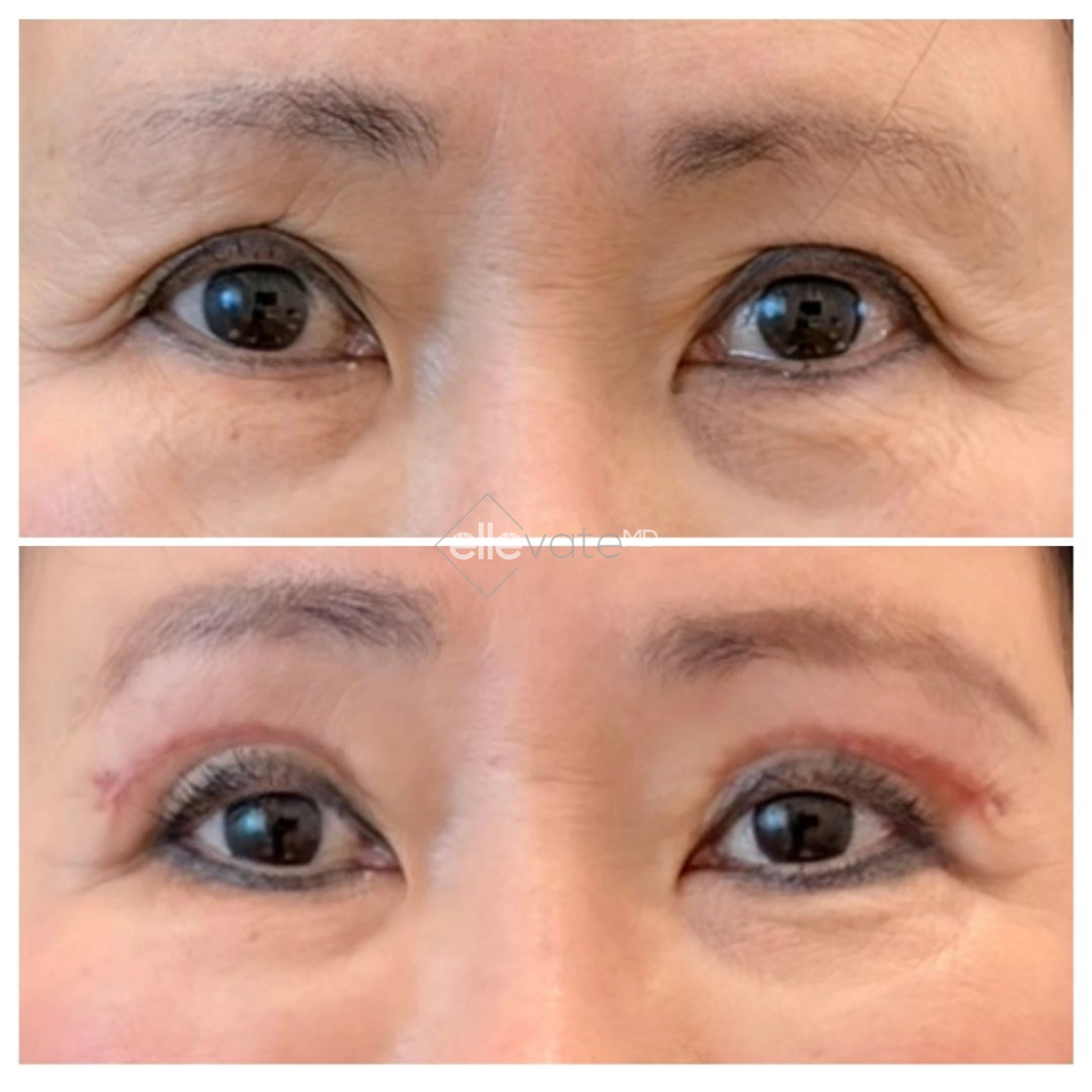 Signature Lift 237 before and after