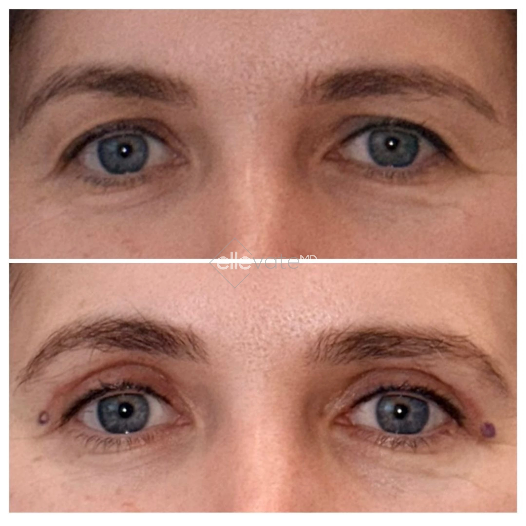 Signature Lift 238 before and after