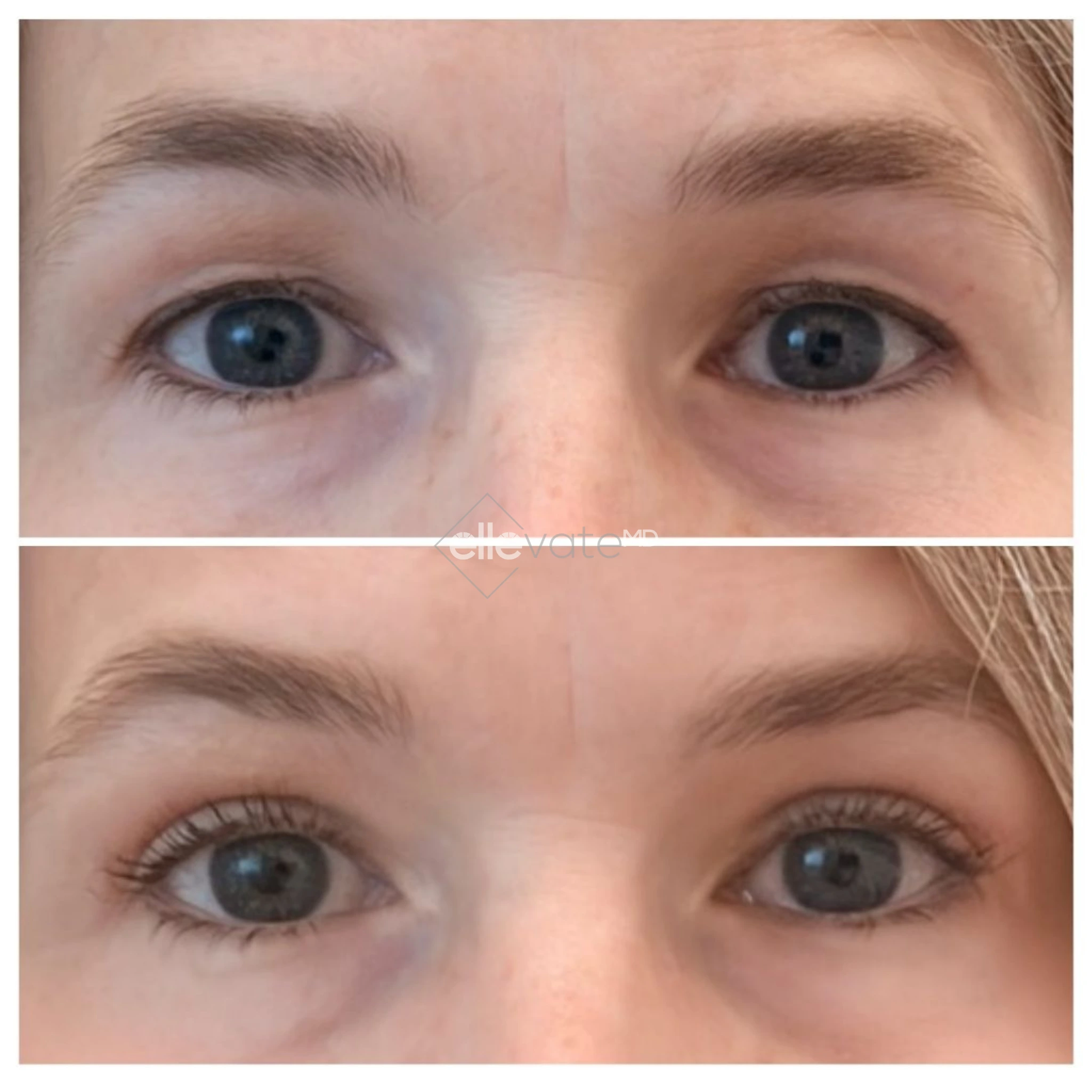 Signature Lift 239 before and after