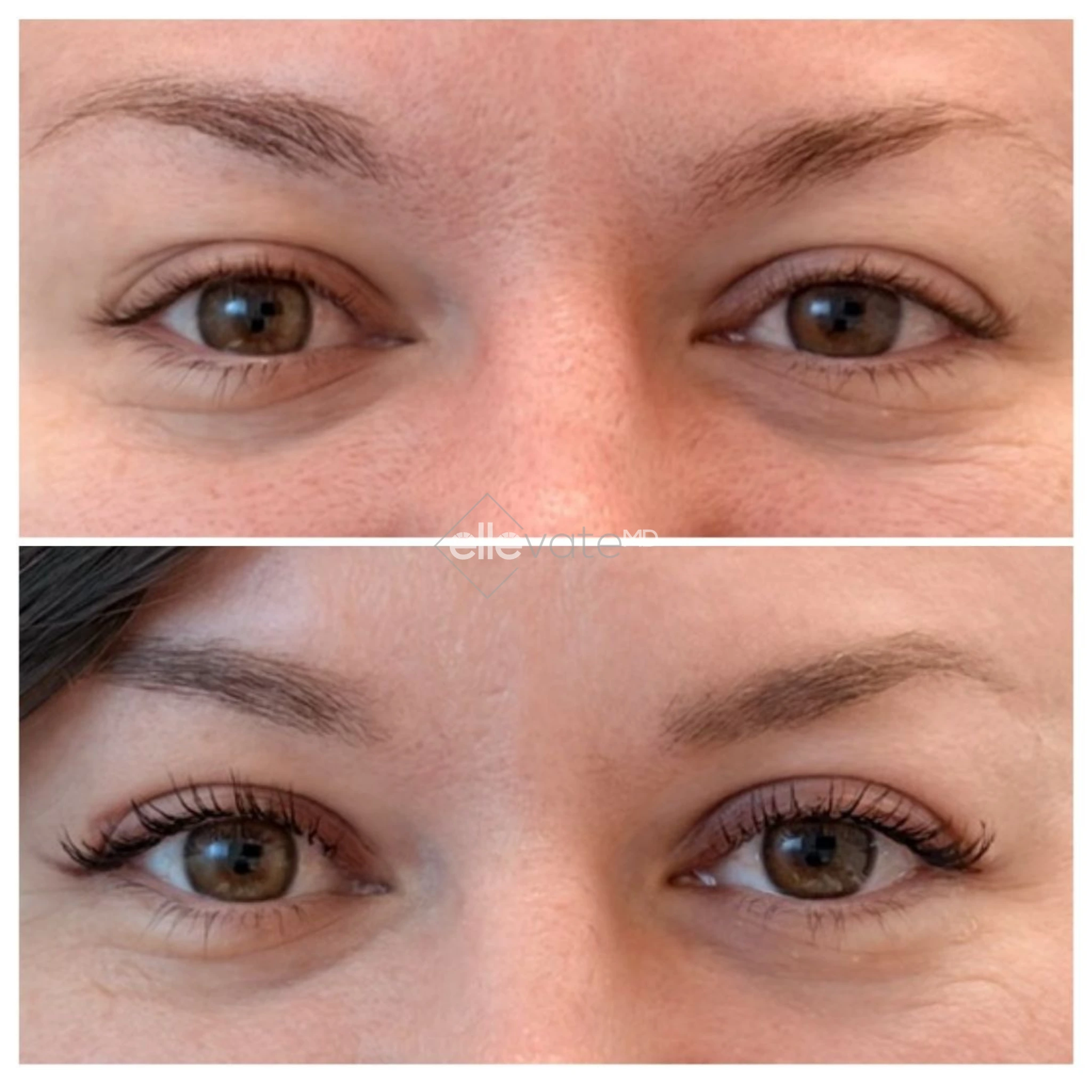 Signature Lift 240 before and after