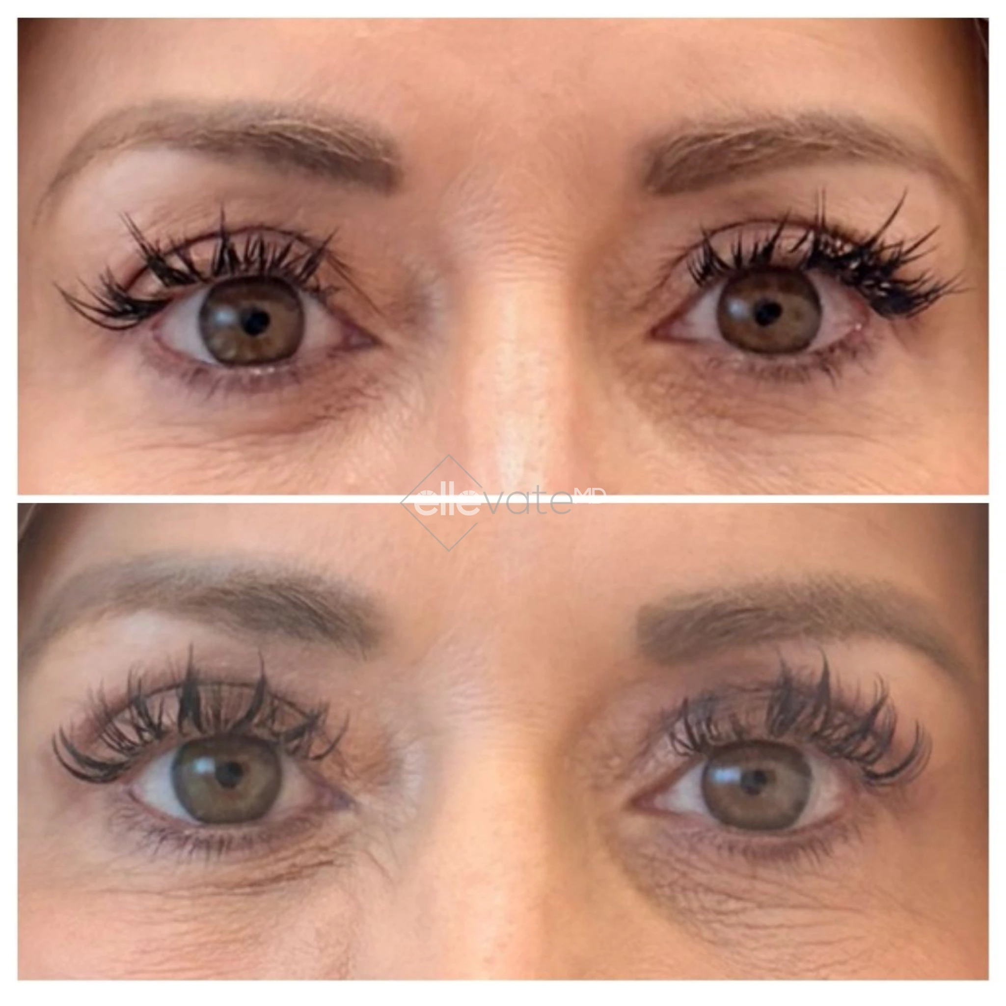 Signature Lift 241 before and after